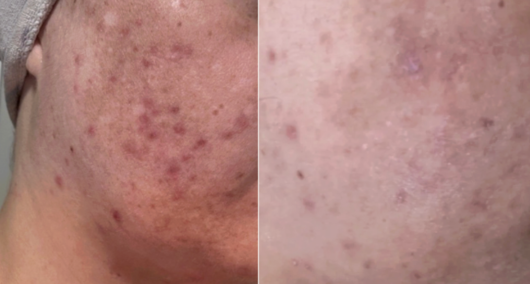 Root cause acne specialist and naturopathic doctor offering virtual 1:1 sessions and functional lab testing to uncover hormonal, gut, and lifestyle imbalances driving acne. Clear your skin from the inside out with personalized, holistic care.