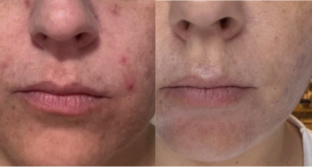 Root cause acne specialist and naturopathic doctor offering virtual 1:1 sessions and functional lab testing to uncover hormonal, gut, and lifestyle imbalances driving acne. Clear your skin from the inside out with personalized, holistic care.