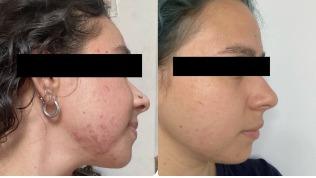 Root cause acne specialist and naturopathic doctor offering virtual 1:1 sessions and functional lab testing to uncover hormonal, gut, and lifestyle imbalances driving acne. Clear your skin from the inside out with personalized, holistic care.
