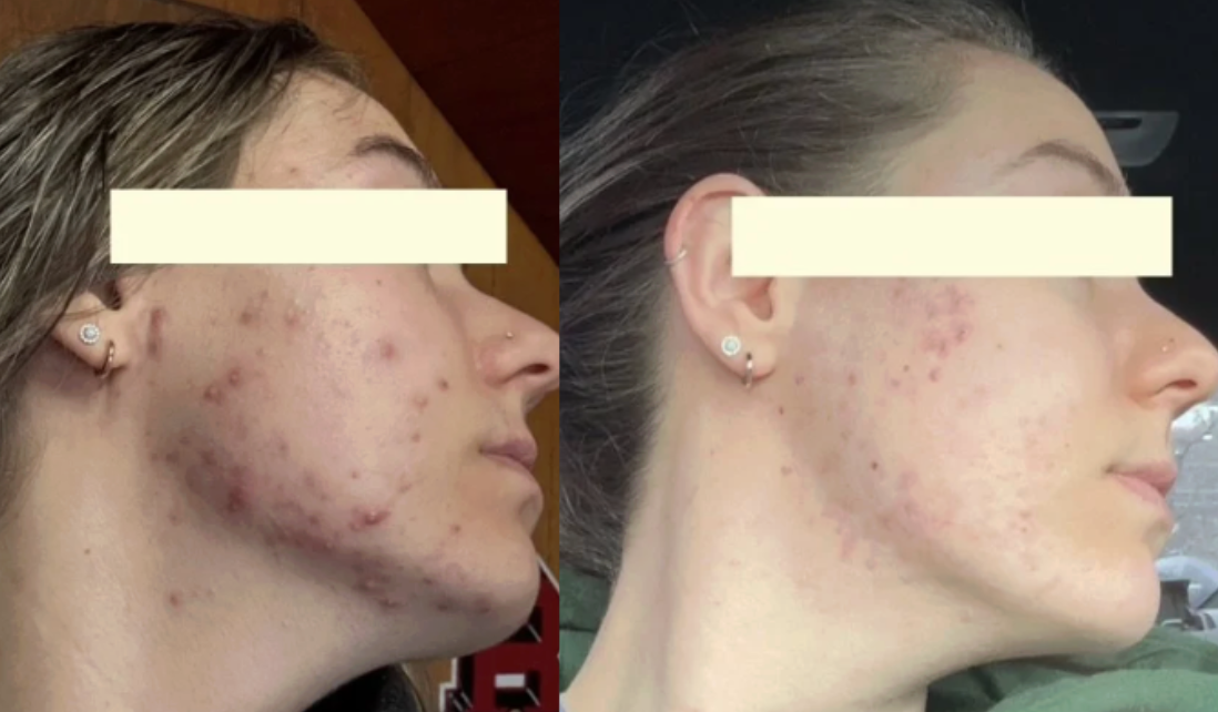 Root cause acne specialist and naturopathic doctor offering virtual 1:1 sessions and functional lab testing to uncover hormonal, gut, and lifestyle imbalances driving acne. Clear your skin from the inside out with personalized, holistic care.