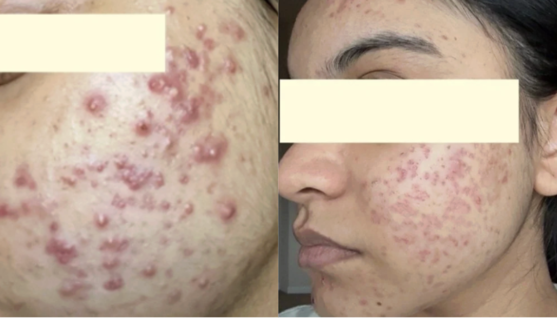 Root cause acne specialist and naturopathic doctor offering virtual 1:1 sessions and functional lab testing to uncover hormonal, gut, and lifestyle imbalances driving acne. Clear your skin from the inside out with personalized, holistic care.