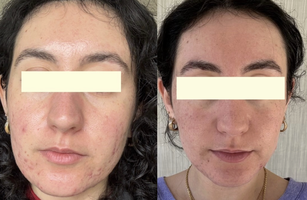 Root cause acne specialist and naturopathic doctor offering virtual 1:1 sessions and functional lab testing to uncover hormonal, gut, and lifestyle imbalances driving acne. Clear your skin from the inside out with personalized, holistic care.