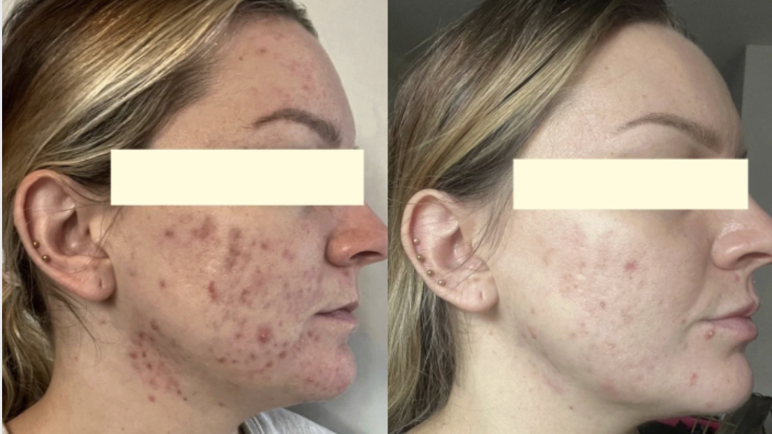 Side-by-side comparison of a woman's face showing severe acne before and improved skin after treatment.