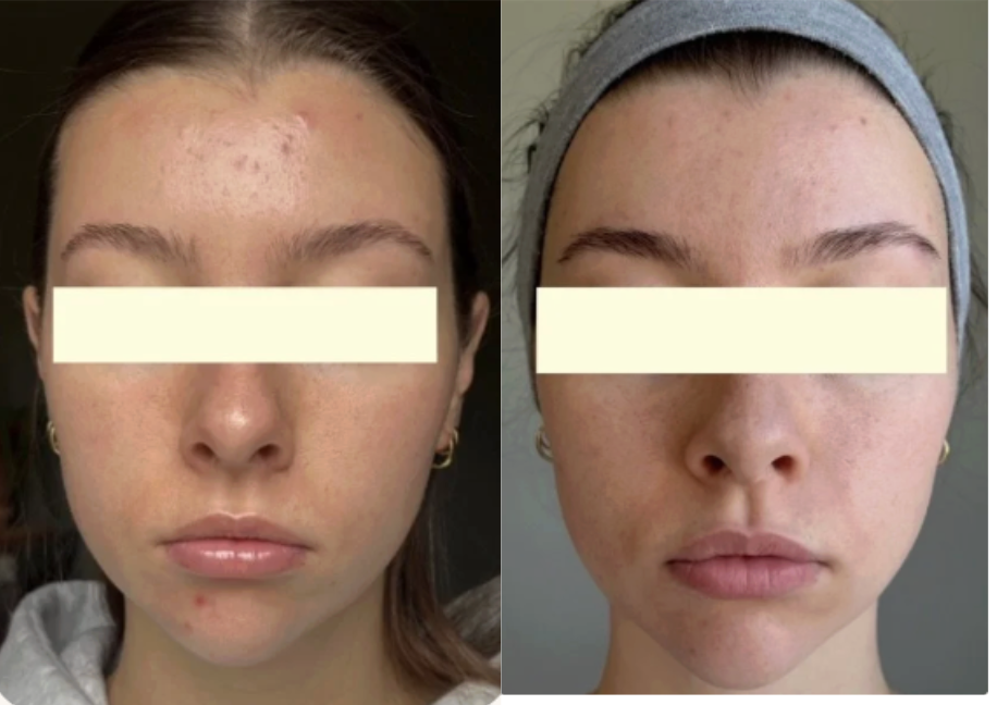 Root cause acne specialist and naturopathic doctor offering virtual 1:1 sessions and functional lab testing to uncover hormonal, gut, and lifestyle imbalances driving acne. Clear your skin from the inside out with personalized, holistic care.
