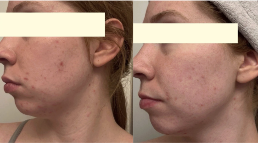 Root cause acne specialist and naturopathic doctor offering virtual 1:1 sessions and functional lab testing to uncover hormonal, gut, and lifestyle imbalances driving acne. Clear your skin from the inside out with personalized, holistic care.
