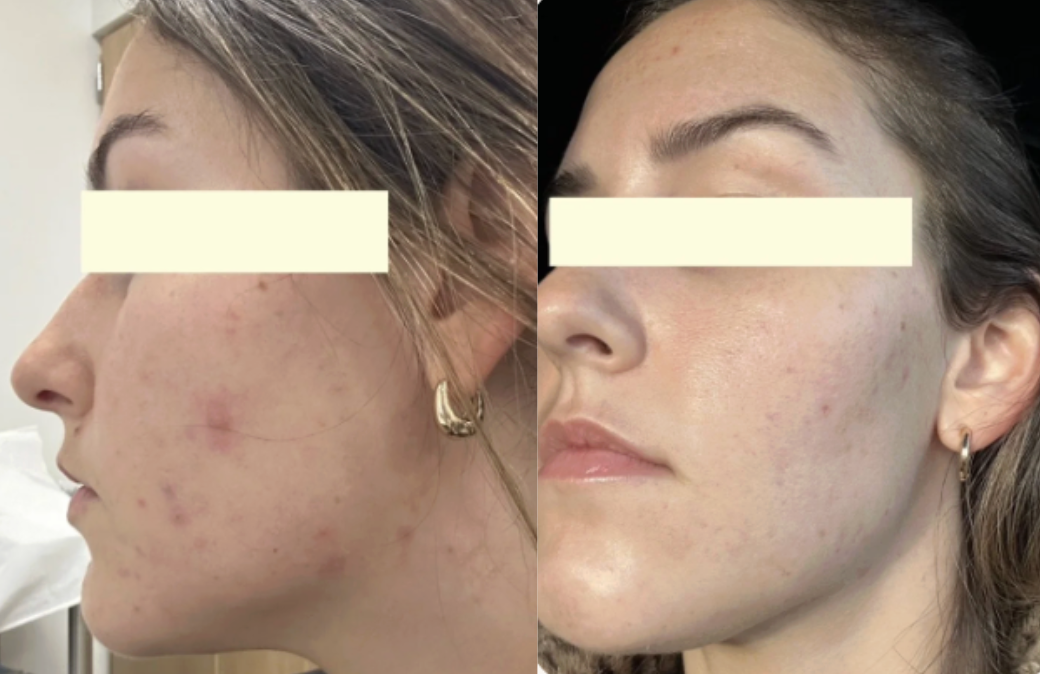 Root cause acne specialist and naturopathic doctor offering virtual 1:1 sessions and functional lab testing to uncover hormonal, gut, and lifestyle imbalances driving acne. Clear your skin from the inside out with personalized, holistic care.
