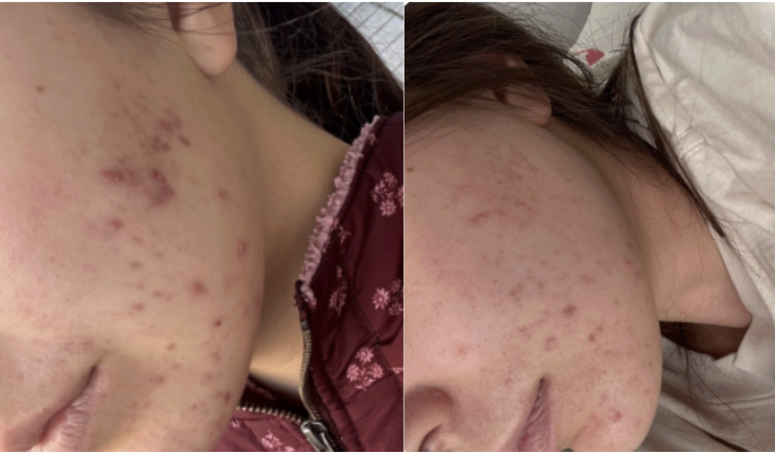 Root cause acne specialist and naturopathic doctor offering virtual 1:1 sessions and functional lab testing to uncover hormonal, gut, and lifestyle imbalances driving acne. Clear your skin from the inside out with personalized, holistic care.