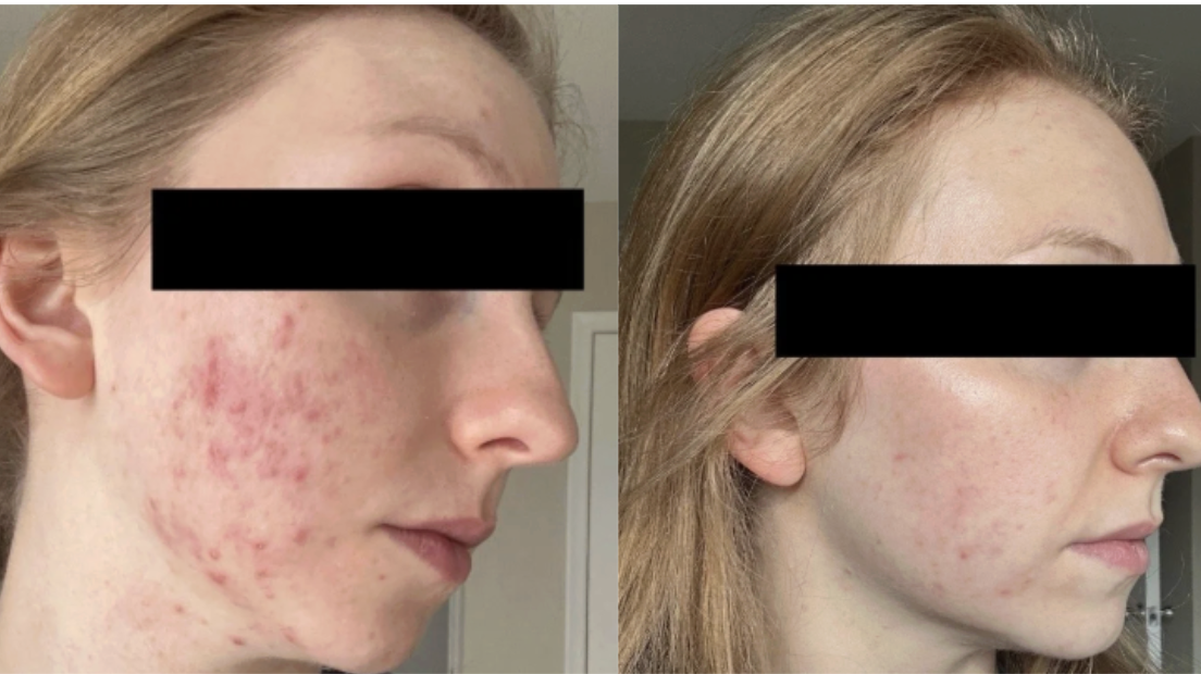 Root cause acne specialist and naturopathic doctor offering virtual 1:1 sessions and functional lab testing to uncover hormonal, gut, and lifestyle imbalances driving acne. Clear your skin from the inside out with personalized, holistic care.