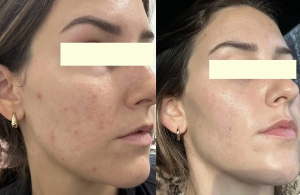 Root cause acne specialist and naturopathic doctor offering virtual 1:1 sessions and functional lab testing to uncover hormonal, gut, and lifestyle imbalances driving acne. Clear your skin from the inside out with personalized, holistic care.