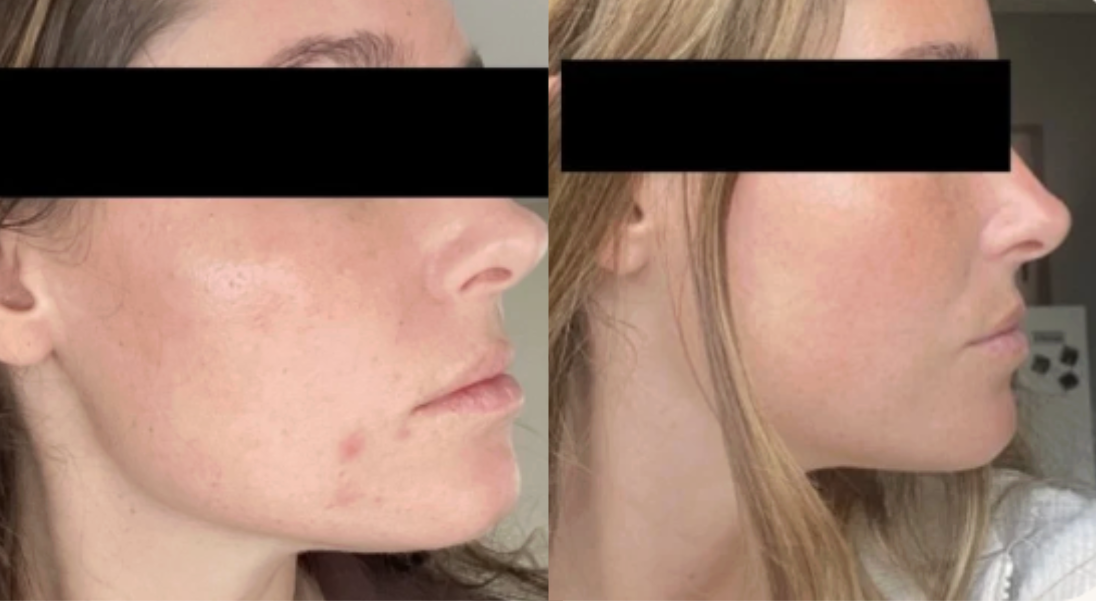Root cause acne specialist and naturopathic doctor offering virtual 1:1 sessions and functional lab testing to uncover hormonal, gut, and lifestyle imbalances driving acne. Clear your skin from the inside out with personalized, holistic care.