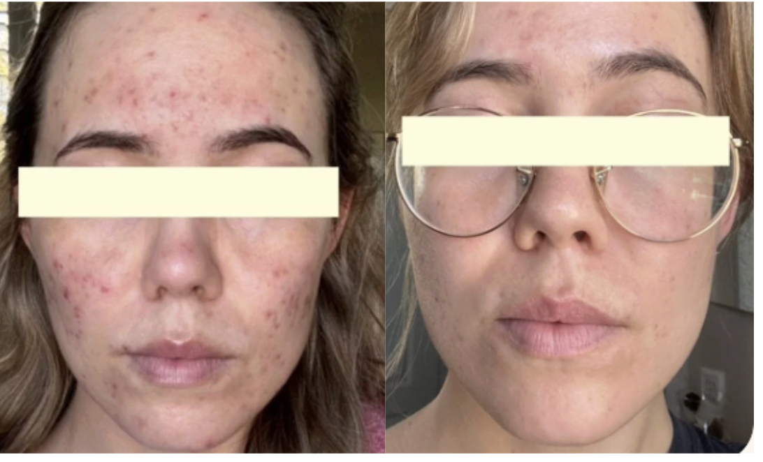 Root cause acne specialist and naturopathic doctor offering virtual 1:1 sessions and functional lab testing to uncover hormonal, gut, and lifestyle imbalances driving acne. Clear your skin from the inside out with personalized, holistic care.