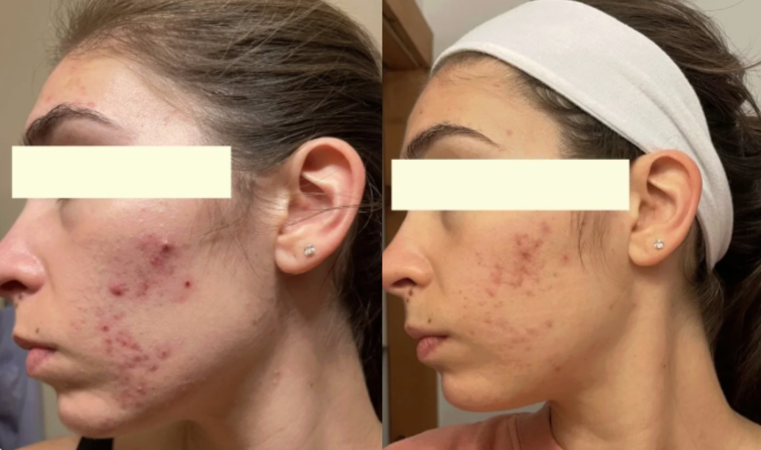 Root cause acne specialist and naturopathic doctor offering virtual 1:1 sessions and functional lab testing to uncover hormonal, gut, and lifestyle imbalances driving acne. Clear your skin from the inside out with personalized, holistic care.