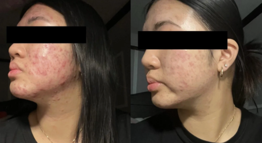 Root cause acne specialist and naturopathic doctor offering virtual 1:1 sessions and functional lab testing to uncover hormonal, gut, and lifestyle imbalances driving acne. Clear your skin from the inside out with personalized, holistic care.