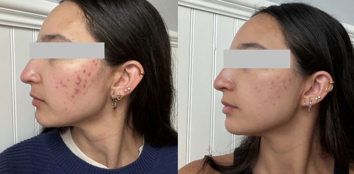 Root cause acne specialist and naturopathic doctor offering virtual 1:1 sessions and functional lab testing to uncover hormonal, gut, and lifestyle imbalances driving acne. Clear your skin from the inside out with personalized, holistic care.