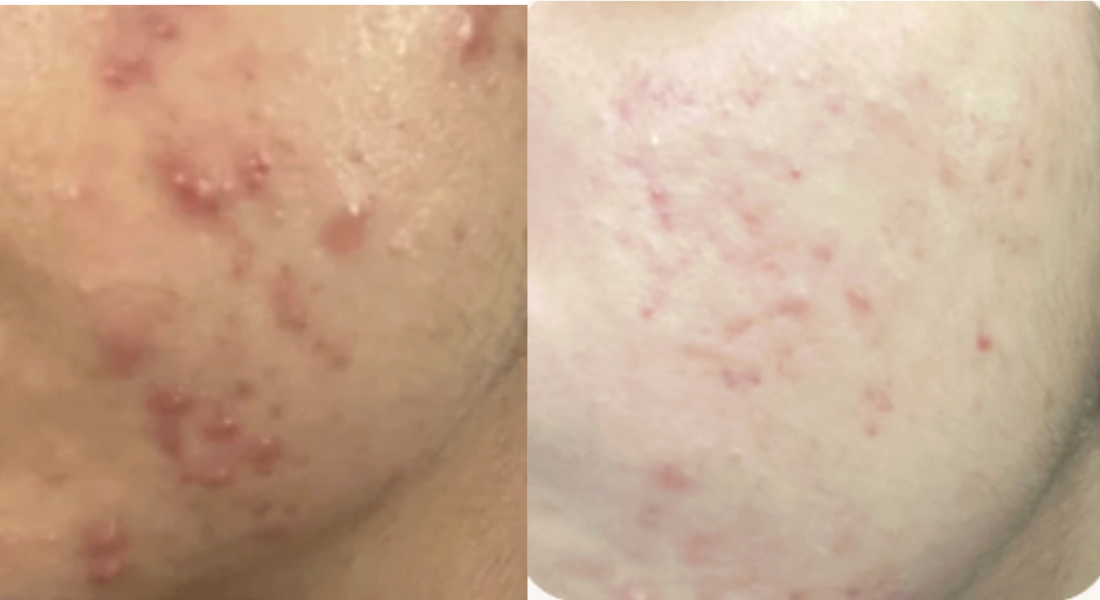 Root cause acne specialist and naturopathic doctor offering virtual 1:1 sessions and functional lab testing to uncover hormonal, gut, and lifestyle imbalances driving acne. Clear your skin from the inside out with personalized, holistic care.