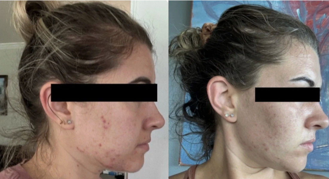 Root cause acne specialist and naturopathic doctor offering virtual 1:1 sessions and functional lab testing to uncover hormonal, gut, and lifestyle imbalances driving acne. Clear your skin from the inside out with personalized, holistic care.