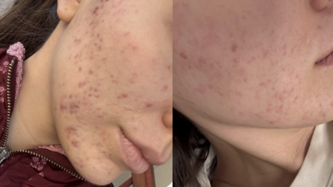 Root cause acne specialist and naturopathic doctor offering virtual 1:1 sessions and functional lab testing to uncover hormonal, gut, and lifestyle imbalances driving acne. Clear your skin from the inside out with personalized, holistic care.