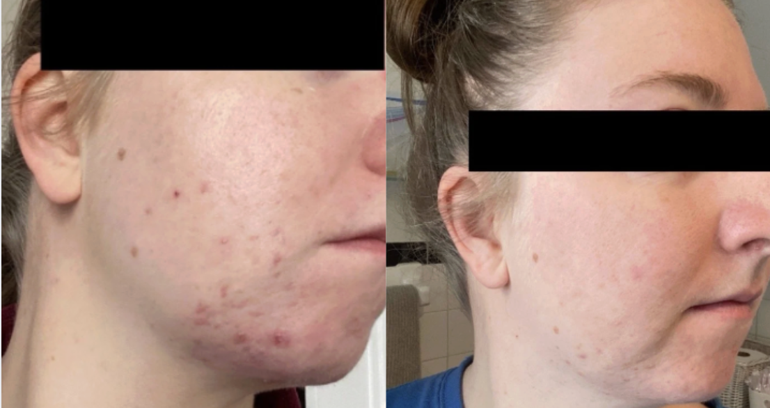 Root cause acne specialist and naturopathic doctor offering virtual 1:1 sessions and functional lab testing to uncover hormonal, gut, and lifestyle imbalances driving acne. Clear your skin from the inside out with personalized, holistic care.
