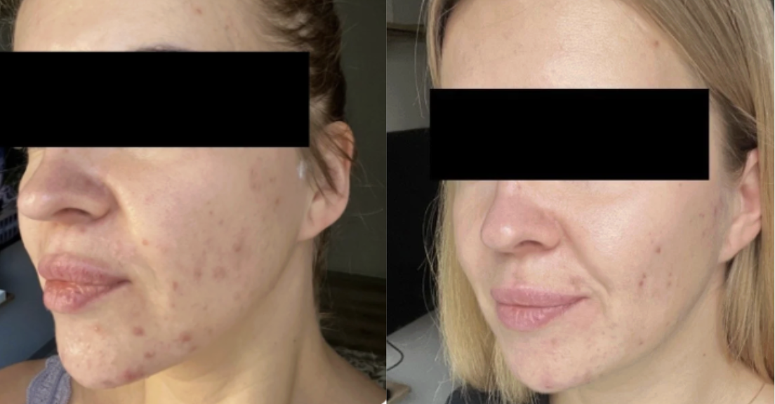 Root cause acne specialist and naturopathic doctor offering virtual 1:1 sessions and functional lab testing to uncover hormonal, gut, and lifestyle imbalances driving acne. Clear your skin from the inside out with personalized, holistic care.