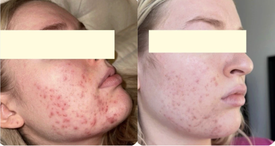 Root cause acne specialist and naturopathic doctor offering virtual 1:1 sessions and functional lab testing to uncover hormonal, gut, and lifestyle imbalances driving acne. Clear your skin from the inside out with personalized, holistic care.