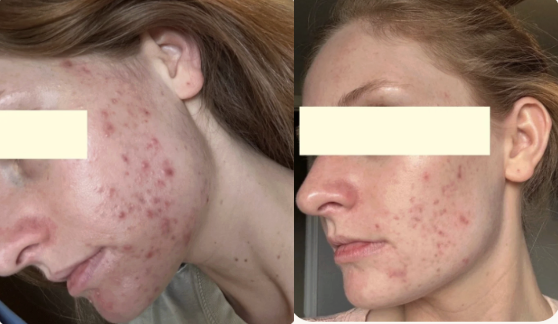 Root cause acne specialist and naturopathic doctor offering virtual 1:1 sessions and functional lab testing to uncover hormonal, gut, and lifestyle imbalances driving acne. Clear your skin from the inside out with personalized, holistic care.