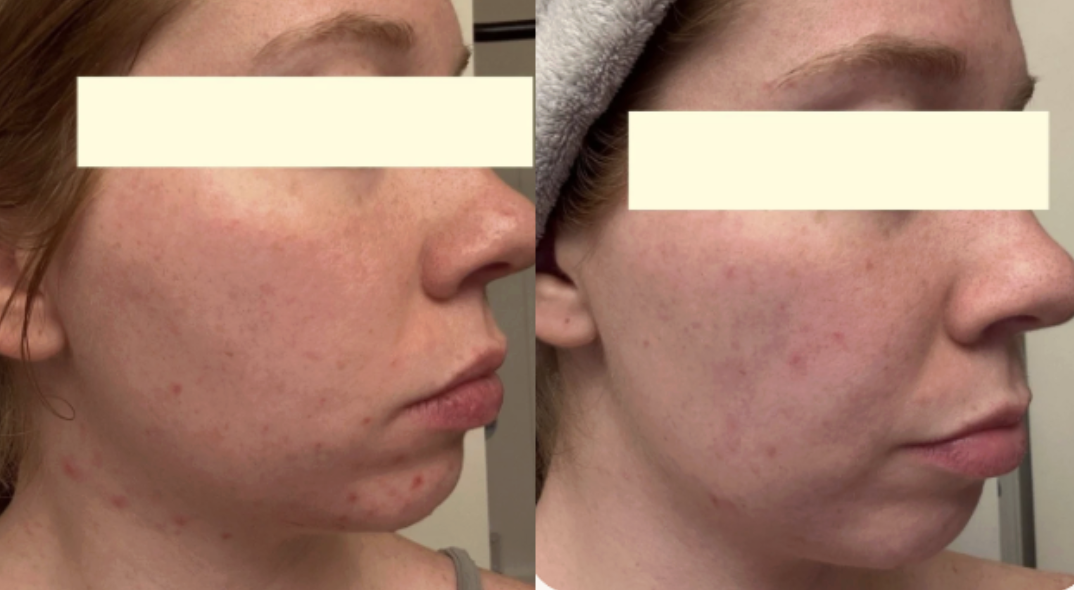 Root cause acne specialist and naturopathic doctor offering virtual 1:1 sessions and functional lab testing to uncover hormonal, gut, and lifestyle imbalances driving acne. Clear your skin from the inside out with personalized, holistic care.