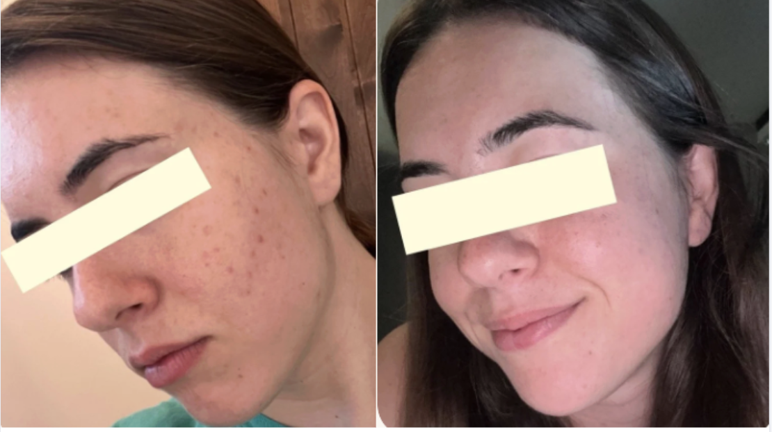 Root cause acne specialist and naturopathic doctor offering virtual 1:1 sessions and functional lab testing to uncover hormonal, gut, and lifestyle imbalances driving acne. Clear your skin from the inside out with personalized, holistic care.