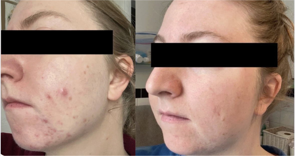 Root cause acne specialist and naturopathic doctor offering virtual 1:1 sessions and functional lab testing to uncover hormonal, gut, and lifestyle imbalances driving acne. Clear your skin from the inside out with personalized, holistic care.