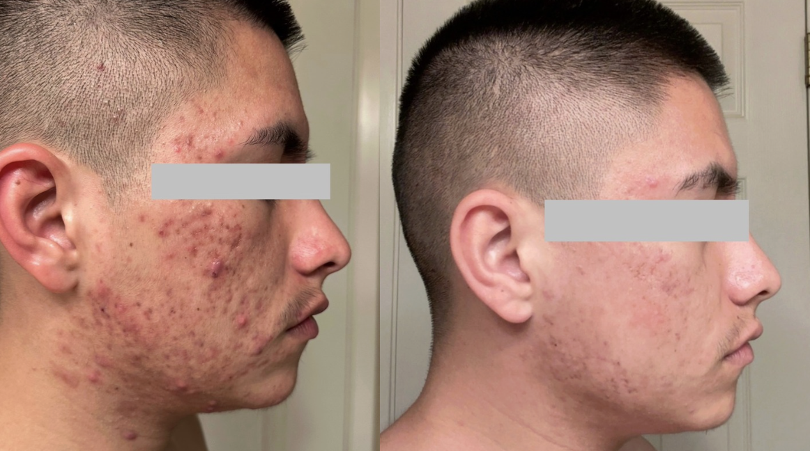 Root cause acne specialist and naturopathic doctor offering virtual 1:1 sessions and functional lab testing to uncover hormonal, gut, and lifestyle imbalances driving acne. Clear your skin from the inside out with personalized, holistic care. Holisti