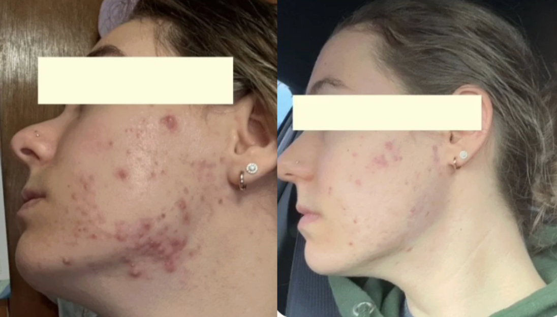 Root cause acne specialist and naturopathic doctor offering virtual 1:1 sessions and functional lab testing to uncover hormonal, gut, and lifestyle imbalances driving acne. Clear your skin from the inside out with personalized, holistic care.