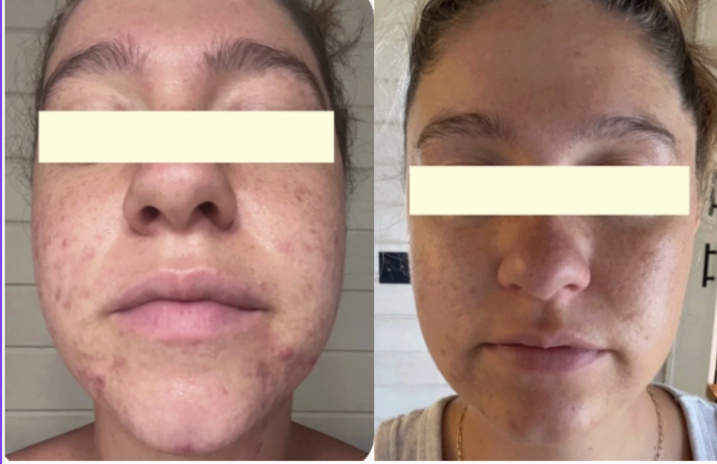 Root cause acne specialist and naturopathic doctor offering virtual 1:1 sessions and functional lab testing to uncover hormonal, gut, and lifestyle imbalances driving acne. Clear your skin from the inside out with personalized, holistic care.