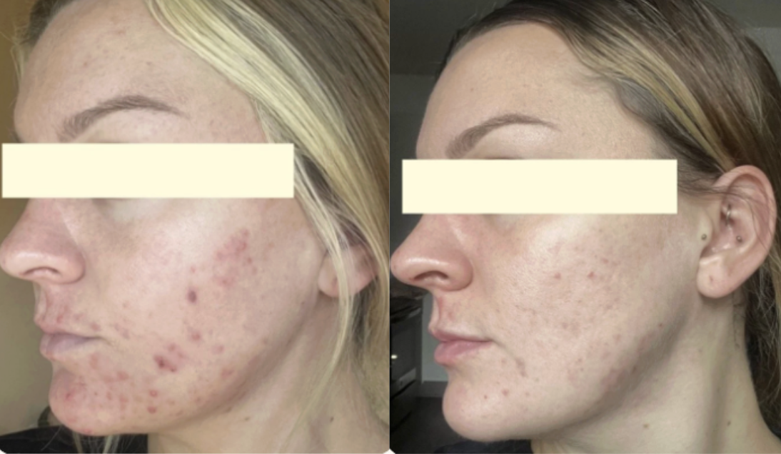 Root cause acne specialist and naturopathic doctor offering virtual 1:1 sessions and functional lab testing to uncover hormonal, gut, and lifestyle imbalances driving acne. Clear your skin from the inside out with personalized, holistic care.