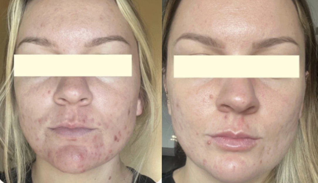 Root cause acne specialist and naturopathic doctor offering virtual 1:1 sessions and functional lab testing to uncover hormonal, gut, and lifestyle imbalances driving acne. Clear your skin from the inside out with personalized, holistic care.