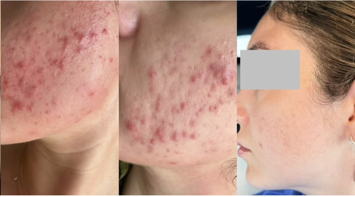 Root cause acne specialist and naturopathic doctor offering virtual 1:1 sessions and functional lab testing to uncover hormonal, gut, and lifestyle imbalances driving acne. Clear your skin from the inside out with personalized, holistic care.