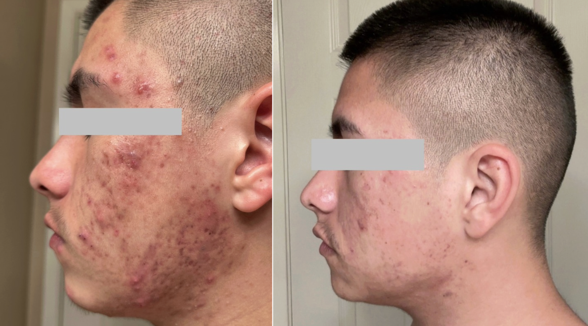Root cause acne specialist and naturopathic doctor offering virtual 1:1 sessions and functional lab testing to uncover hormonal, gut, and lifestyle imbalances driving acne. Clear your skin from the inside out with personalized, holistic care. Holisti