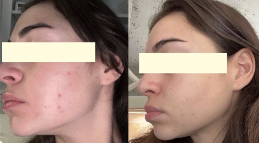 Root cause acne specialist and naturopathic doctor offering virtual 1:1 sessions and functional lab testing to uncover hormonal, gut, and lifestyle imbalances driving acne. Clear your skin from the inside out with personalized, holistic care.