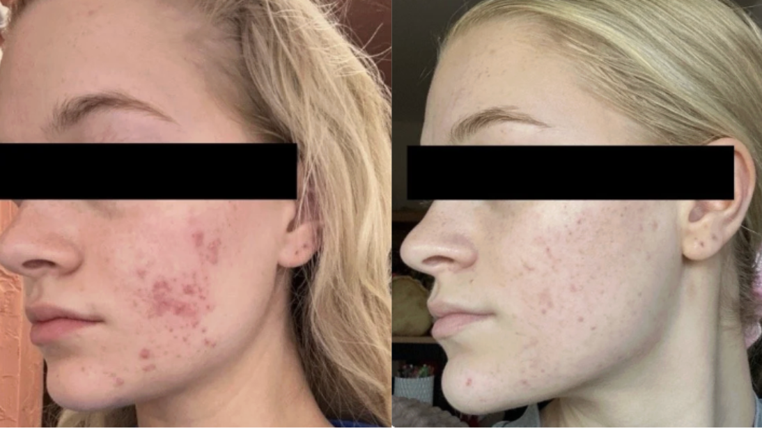 Root cause acne specialist and naturopathic doctor offering virtual 1:1 sessions and functional lab testing to uncover hormonal, gut, and lifestyle imbalances driving acne. Clear your skin from the inside out with personalized, holistic care.