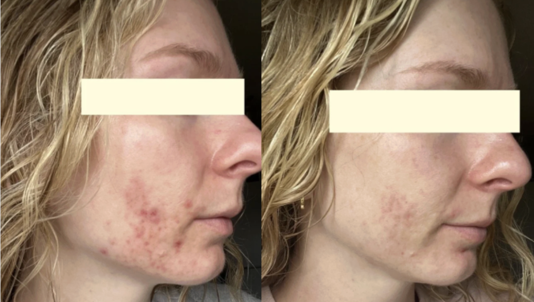 Root cause acne specialist and naturopathic doctor offering virtual 1:1 sessions and functional lab testing to uncover hormonal, gut, and lifestyle imbalances driving acne. Clear your skin from the inside out with personalized, holistic care.