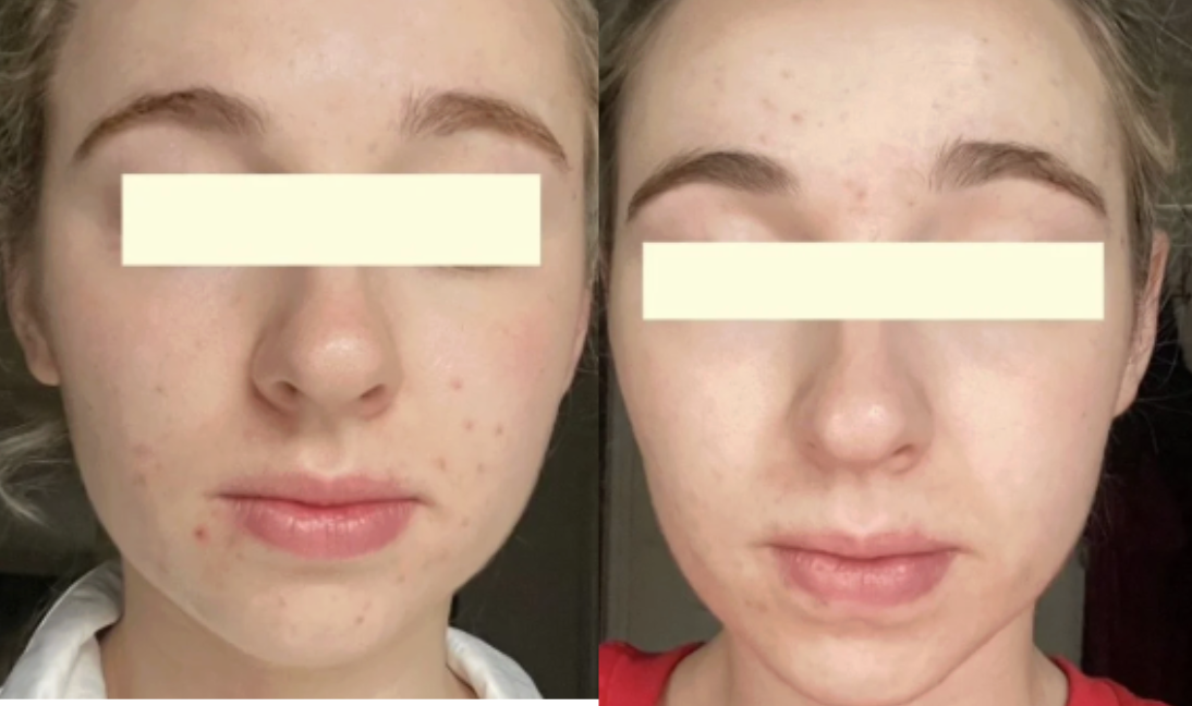 Root cause acne specialist and naturopathic doctor offering virtual 1:1 sessions and functional lab testing to uncover hormonal, gut, and lifestyle imbalances driving acne. Clear your skin from the inside out with personalized, holistic care.