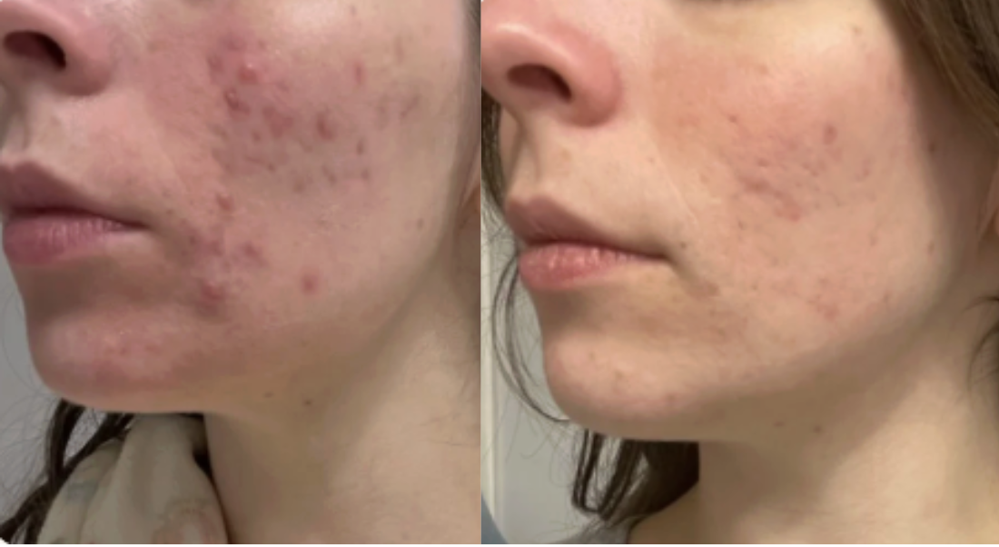 Root cause acne specialist and naturopathic doctor offering virtual 1:1 sessions and functional lab testing to uncover hormonal, gut, and lifestyle imbalances driving acne. Clear your skin from the inside out with personalized, holistic care.