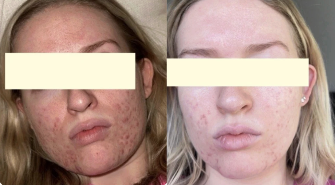 Root cause acne specialist and naturopathic doctor offering virtual 1:1 sessions and functional lab testing to uncover hormonal, gut, and lifestyle imbalances driving acne. Clear your skin from the inside out with personalized, holistic care.