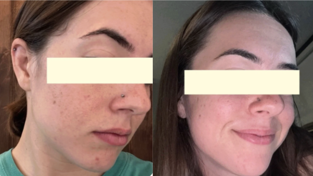 Root cause acne specialist and naturopathic doctor offering virtual 1:1 sessions and functional lab testing to uncover hormonal, gut, and lifestyle imbalances driving acne. Clear your skin from the inside out with personalized, holistic care.