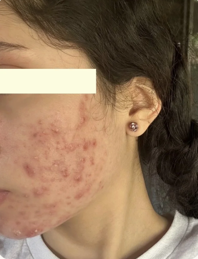 Close-up of a person's face showing acne scars and pustules on the cheek and jawline.