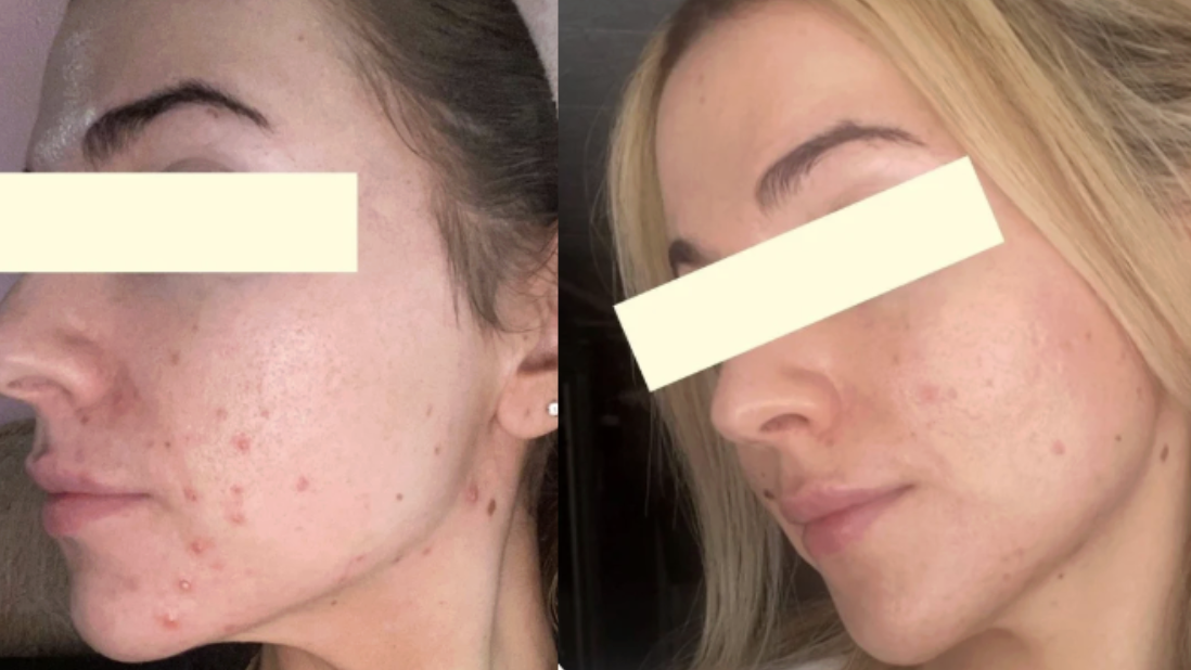 Root cause acne specialist and naturopathic doctor offering virtual 1:1 sessions and functional lab testing to uncover hormonal, gut, and lifestyle imbalances driving acne. Clear your skin from the inside out with personalized, holistic care.