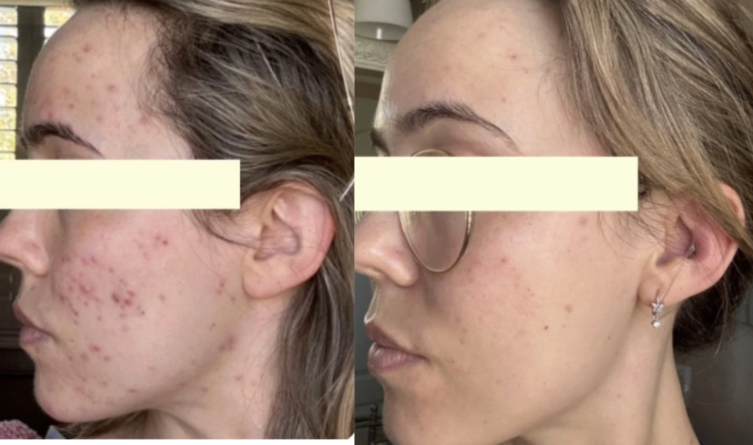 Root cause acne specialist and naturopathic doctor offering virtual 1:1 sessions and functional lab testing to uncover hormonal, gut, and lifestyle imbalances driving acne. Clear your skin from the inside out with personalized, holistic care.