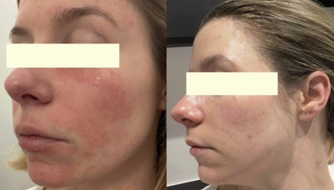 Root cause acne specialist and naturopathic doctor offering virtual 1:1 sessions and functional lab testing to uncover hormonal, gut, and lifestyle imbalances driving acne. Clear your skin from the inside out with personalized, holistic care.