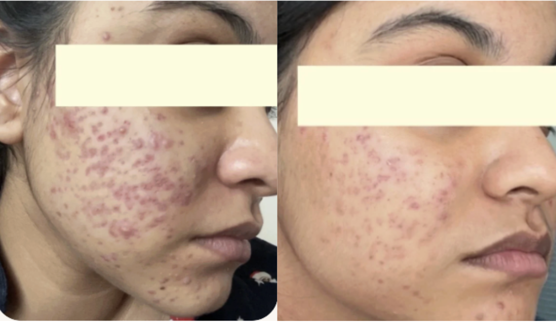 Root cause acne specialist and naturopathic doctor offering virtual 1:1 sessions and functional lab testing to uncover hormonal, gut, and lifestyle imbalances driving acne. Clear your skin from the inside out with personalized, holistic care.