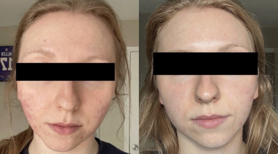 Root cause acne specialist and naturopathic doctor offering virtual 1:1 sessions and functional lab testing to uncover hormonal, gut, and lifestyle imbalances driving acne. Clear your skin from the inside out with personalized, holistic care.