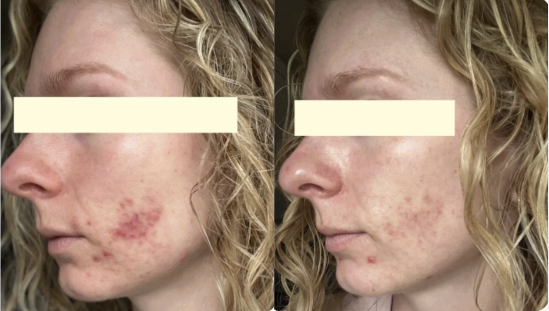 Root cause acne specialist and naturopathic doctor offering virtual 1:1 sessions and functional lab testing to uncover hormonal, gut, and lifestyle imbalances driving acne. Clear your skin from the inside out with personalized, holistic care.