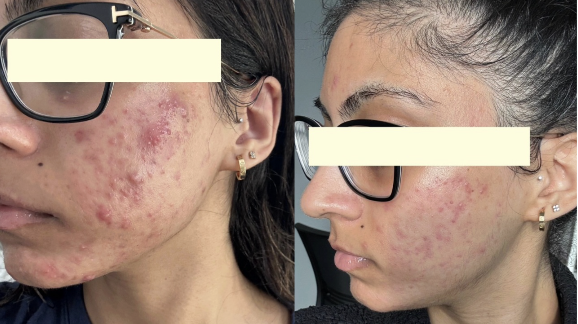 Root cause acne specialist and naturopathic doctor offering virtual 1:1 sessions and functional lab testing to uncover hormonal, gut, and lifestyle imbalances driving acne. Clear your skin from the inside out with personalized, holistic care.